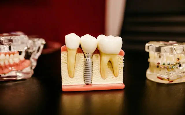 A dental implant model